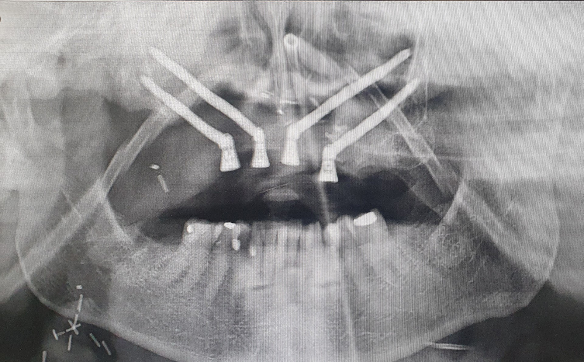 X-Ray photo