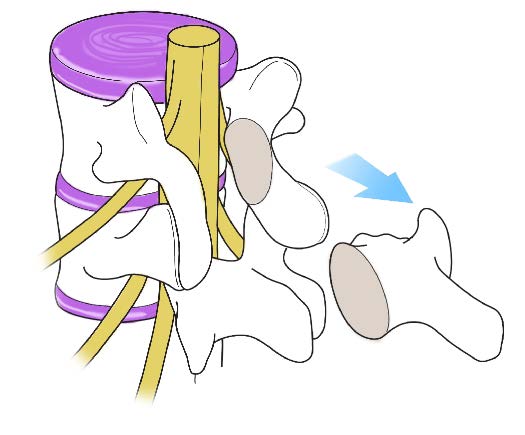 Decompressed Nerve Diagram