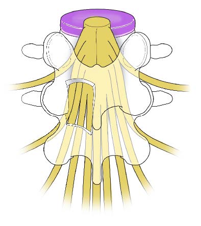 Decompressed nerve