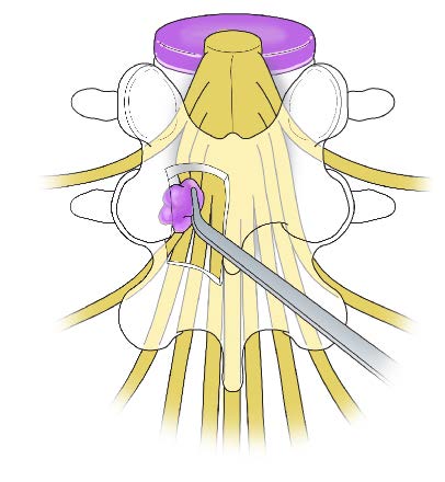 Removal of ruptured region of disc