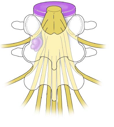 Ruptured disc