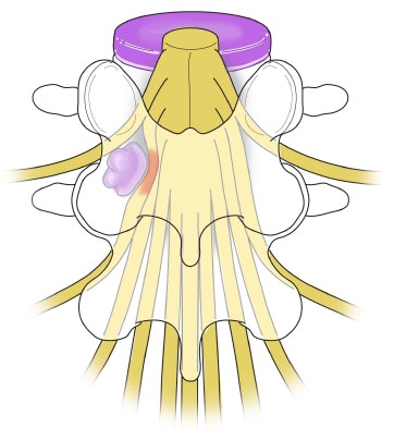 Illustration of a spine with slipped disc