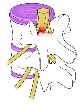 Spinal Stenosis Diagram